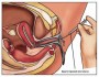 Intrauterine Insemination (IUI)