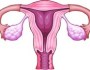 Fibroid – Adakah ia boleh menjejaskan peluang anda untuk&nbsp;hamil?