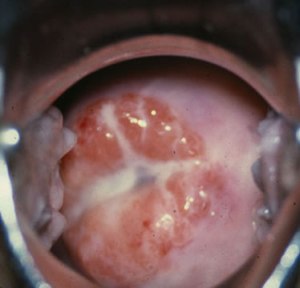 Keputihan yang dilihat melalui pemeriksaan faraj